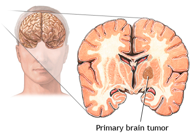 Primary Brain Tumor