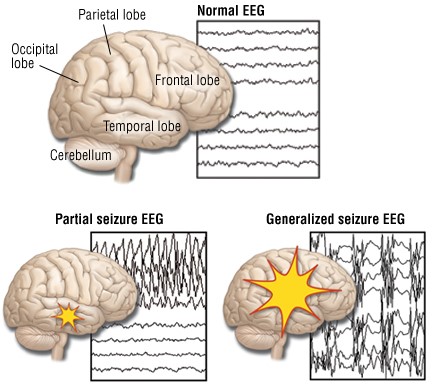 Seizures