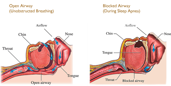 Sleep Apnea