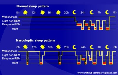 Normal Vs Narcoleptic Sleep Pattern